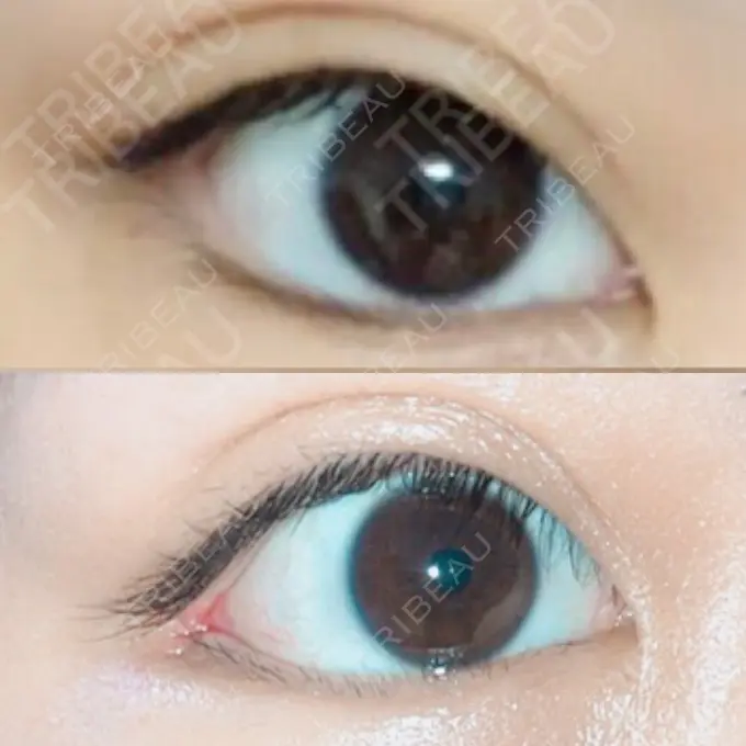 目尻切開 / タレ目形成・グラマラスライン（切開） / 目尻靭帯移動 FROM B整形外科 (旧バウム整形外科) DAY 50 メイン用