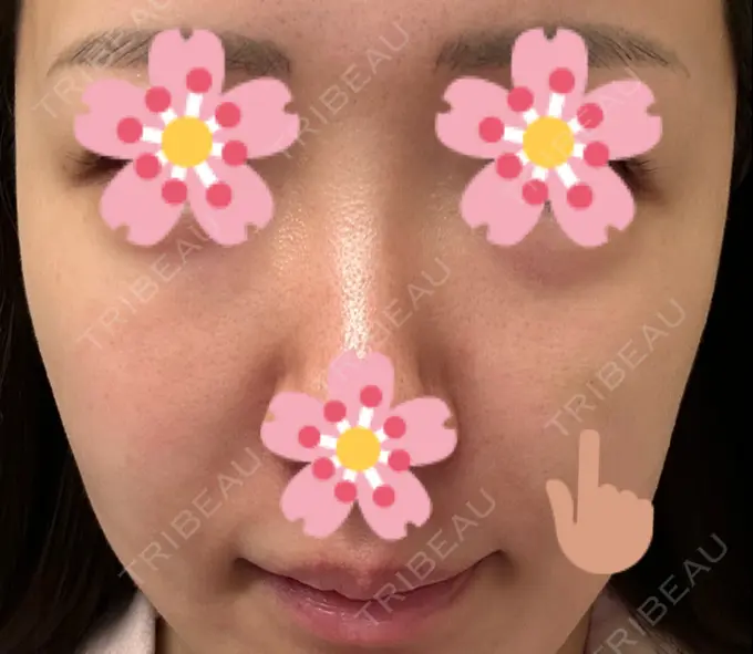 ヒアルロン酸注入（頬） 湘南美容クリニック 宇都宮院 DAY 4 メイン用