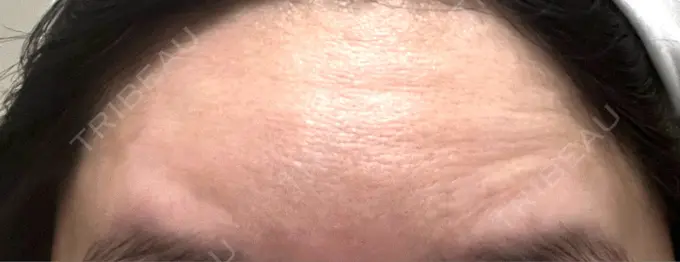 ボトックス（額） 湘南美容クリニック 大阪あべの院 DAY 4 メイン用