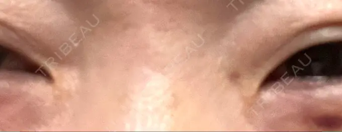 その他（目元） 湘南美容クリニック 大阪あべの院 DAY 4 メイン用