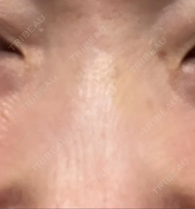 その他（鼻） 湘南美容クリニック 大阪あべの院 DAY 4 メイン用