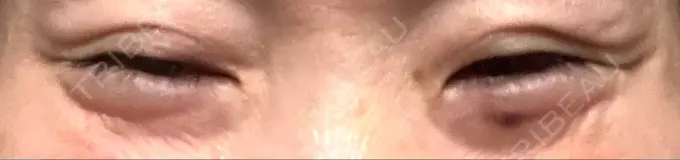 ボトックス（目尻） 湘南美容クリニック 大阪あべの院 DAY 4 メイン用