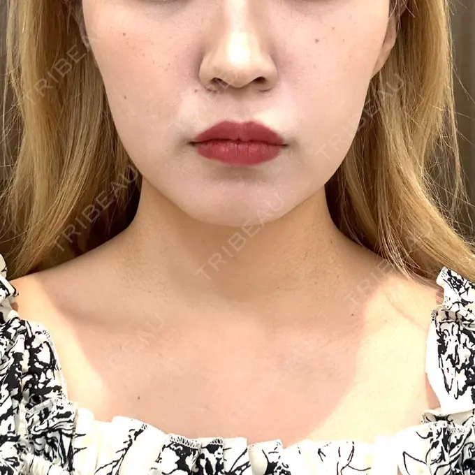 ボトックス（エラ・小顔） 東京シンデレラ美容外科 池袋院 DAY 7 メイン用