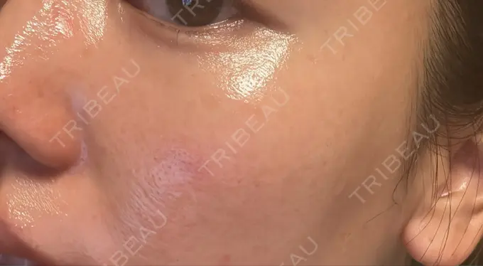 イオン導入 / ルメッカ ルラ美容クリニック 名古屋本院 DAY 5 メイン用