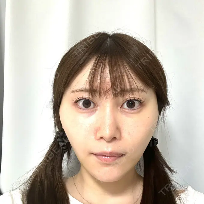 糸リフト / 脂肪吸引（顔） Tokyo Tensei Clinic 新宿院 DAY 8 メイン用