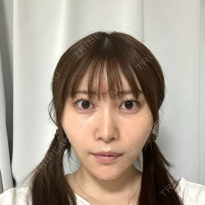 糸リフト / 脂肪吸引（顔） Tokyo Tensei Clinic 新宿院 DAY 9 メイン用