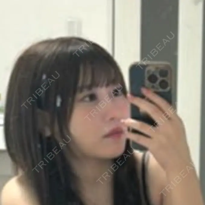 糸リフト / 脂肪吸引（顔） Tokyo Tensei Clinic 新宿院 DAY 10 メイン用