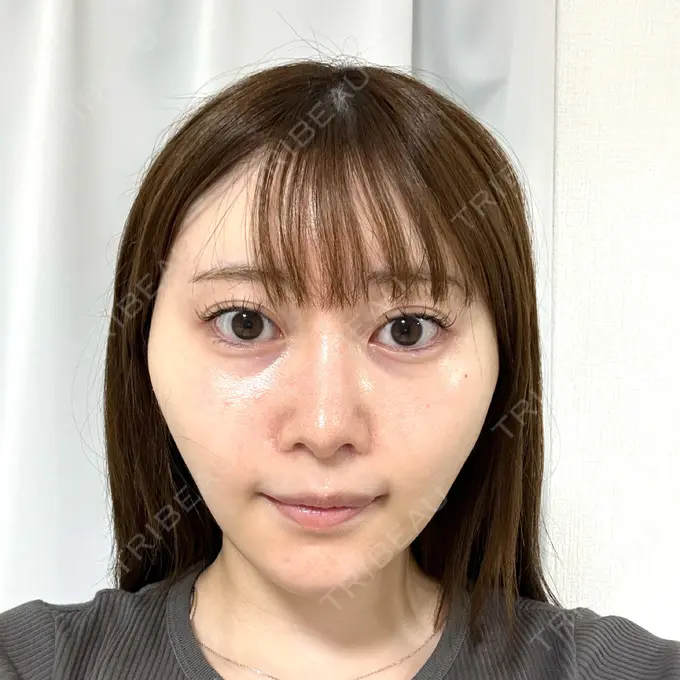 糸リフト / 脂肪吸引（顔） Tokyo Tensei Clinic 新宿院 DAY 11 メイン用