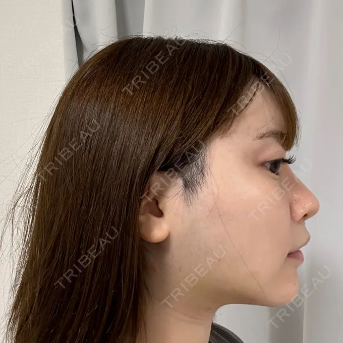 糸リフト / 脂肪吸引（顔） Tokyo Tensei Clinic 新宿院 DAY 11 メイン用