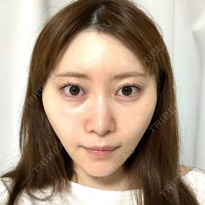 糸リフト / 脂肪吸引（顔） Tokyo Tensei Clinic 新宿院 DAY 12 メイン用