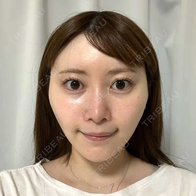 糸リフト / 脂肪吸引（顔） Tokyo Tensei Clinic 新宿院 DAY 15 メイン用