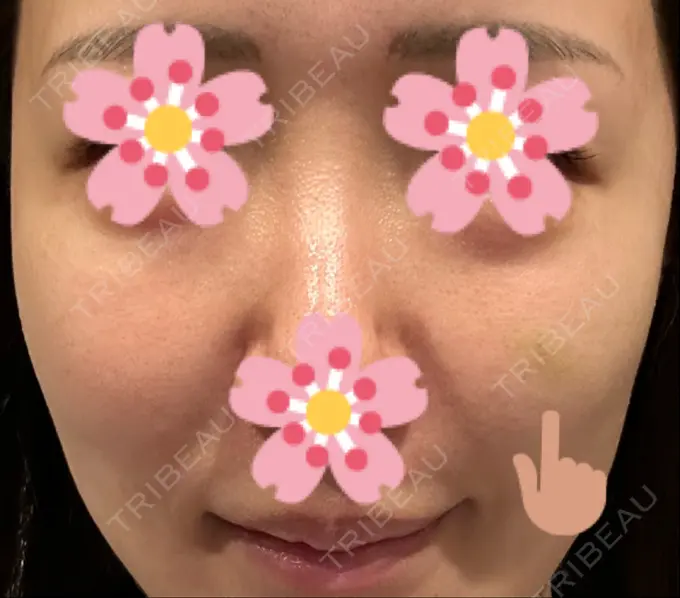 ヒアルロン酸注入（頬） 湘南美容クリニック 宇都宮院 DAY 5 メイン用