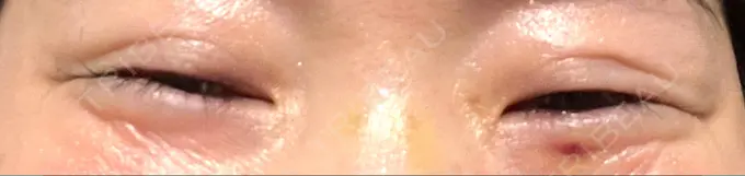 ボトックス（目尻） 湘南美容クリニック 大阪あべの院 DAY 5 メイン用