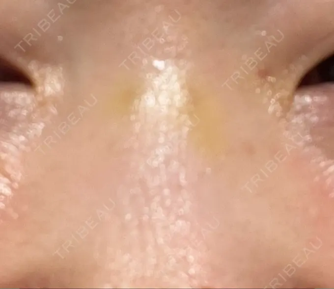 その他（鼻） 湘南美容クリニック 大阪あべの院 DAY 5 メイン用