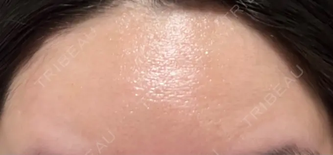 ボトックス（額） 湘南美容クリニック 大阪あべの院 DAY 5 メイン用