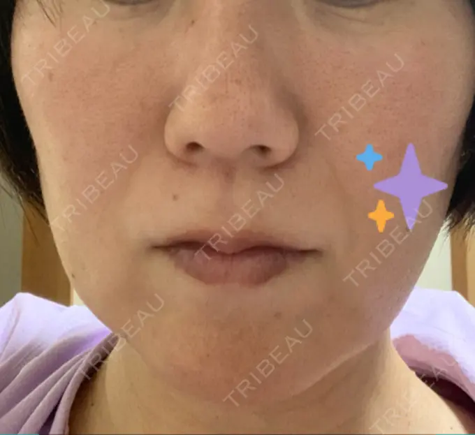 糸リフト 吉井クリニック AFTER メイン用