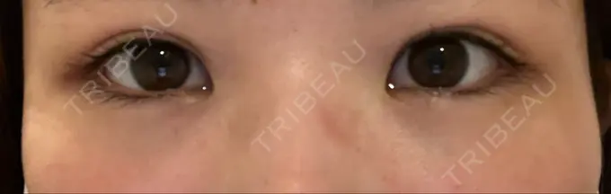 クマ治療 / 下まぶたの脂肪取り Brandnew Beauty Clinic DAY 0 メイン用