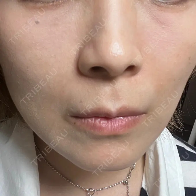 糸リフト 東京シンデレラ美容外科 池袋院 DAY 15 メイン用