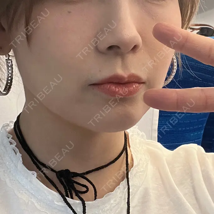 糸リフト 東京シンデレラ美容外科 池袋院 DAY 18 メイン用