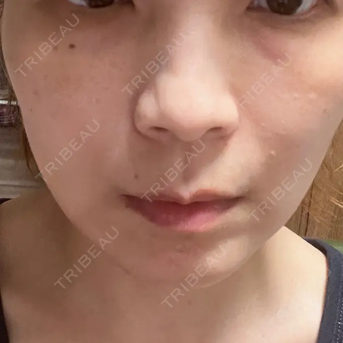 糸リフト 東京シンデレラ美容外科 池袋院 DAY 22 メイン用