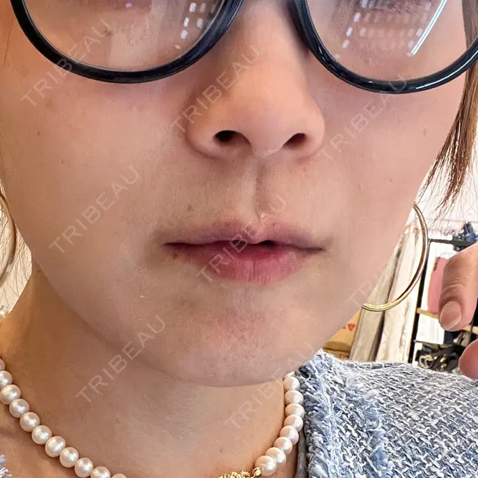 糸リフト 東京シンデレラ美容外科 池袋院 DAY 23 メイン用