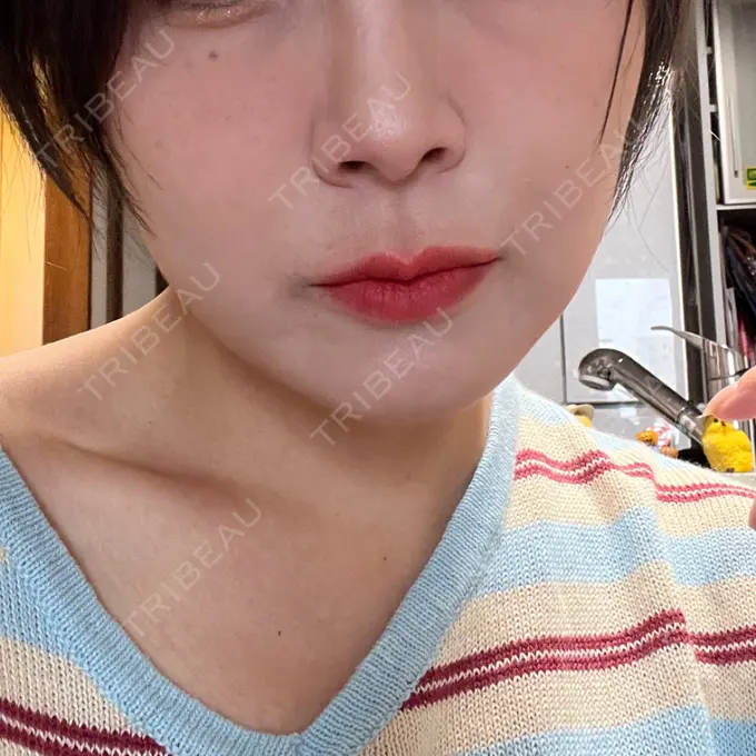 糸リフト 東京シンデレラ美容外科 池袋院 DAY 26 メイン用