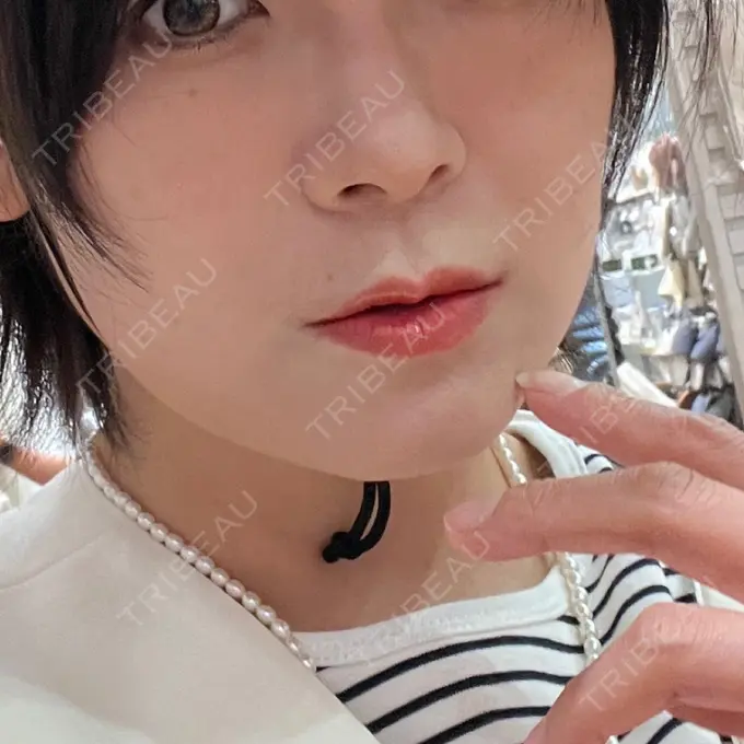 糸リフト 東京シンデレラ美容外科 池袋院 DAY 28 メイン用