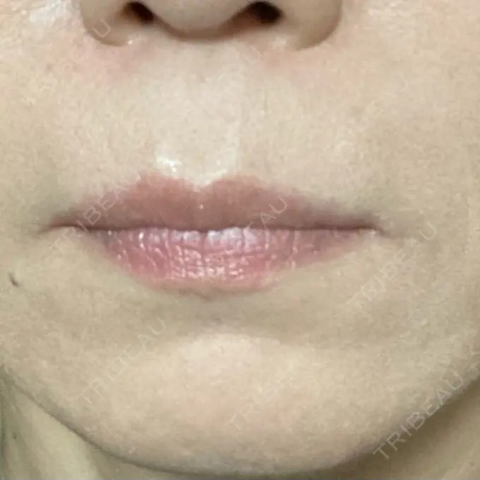 ボトックス（人中） veary clinic AFTER メイン用