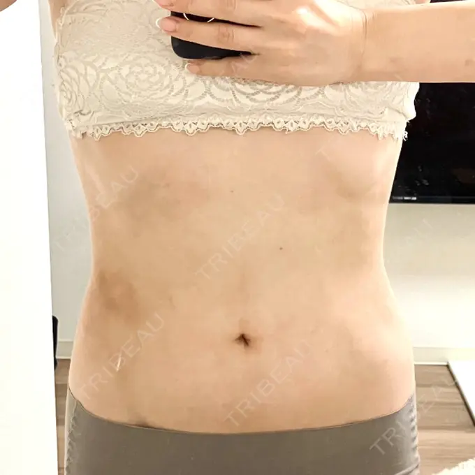 脂肪吸引（顔） / 脂肪吸引（お腹） Mods Clinic（モッズクリニック） 名古屋院 AFTER メイン用