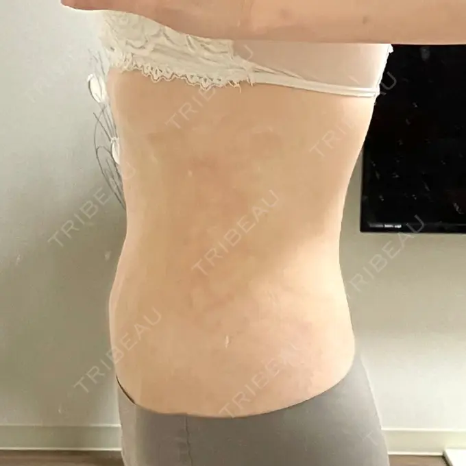 脂肪吸引（顔） / 脂肪吸引（お腹） Mods Clinic（モッズクリニック） 名古屋院 DAY 193 メイン用