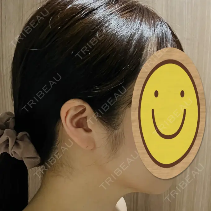 脂肪吸引（顔） / 脂肪吸引（お腹） Mods Clinic（モッズクリニック） 名古屋院 DAY 193 メイン用