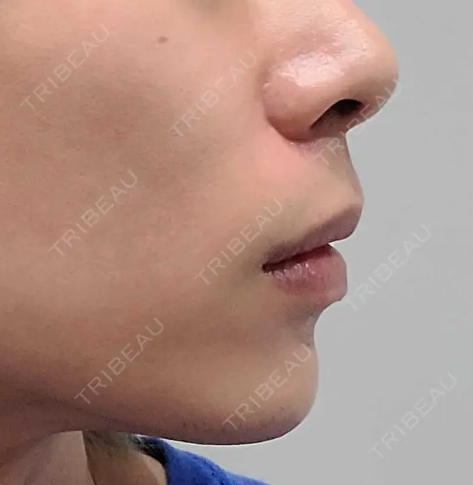 ヒアルロン酸注入（あご） Otus Clinic 【オータスクリニック】 DAY 3 メイン用