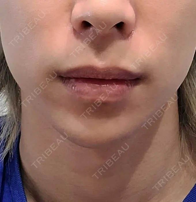 ヒアルロン酸注入（あご） Otus Clinic 【オータスクリニック】 AFTER メイン用