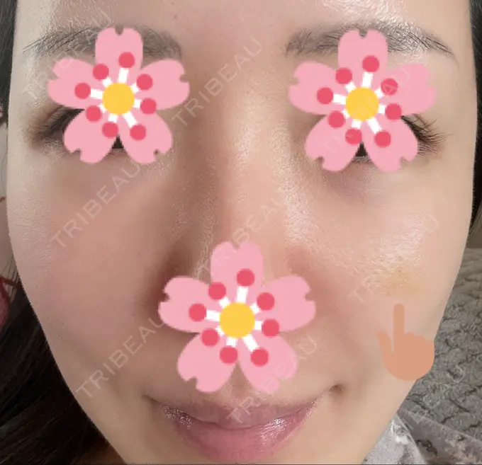 ヒアルロン酸注入（頬） 湘南美容クリニック 宇都宮院 DAY 6 メイン用