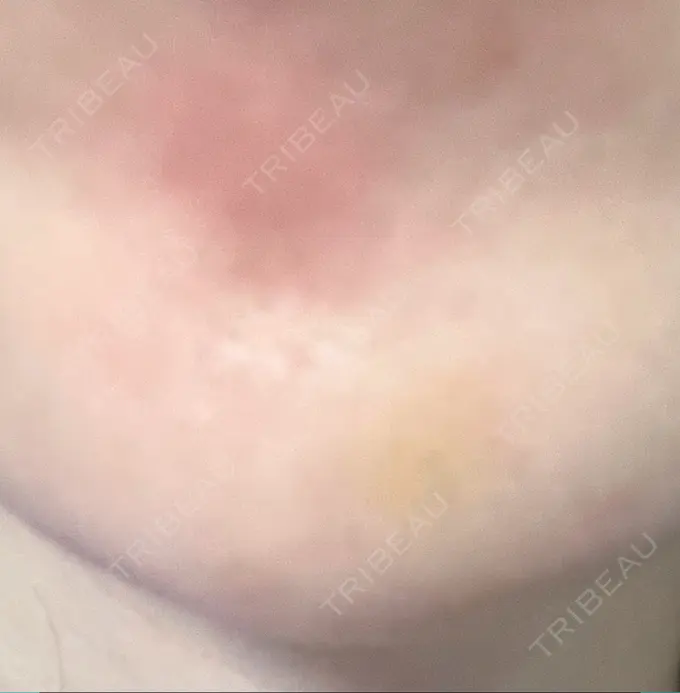 ボトックス（あご） 湘南美容クリニック 大阪あべの院 DAY 5 メイン用