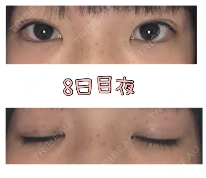 二重埋没 品川スキンクリニック広島院 DAY 8 メイン用