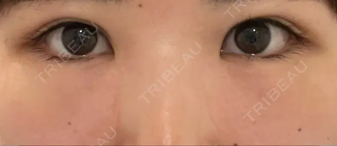 クマ治療 / 下まぶたの脂肪取り Brandnew Beauty Clinic DAY 1 メイン用