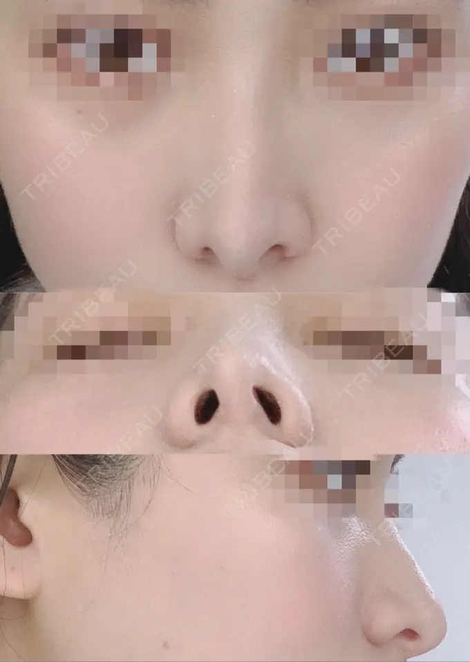 鼻尖形成（切開） / 鼻中隔延長（切開） / 骨切幅寄せ / 鼻修正 湘南美容クリニック 新橋銀座口院 AFTER メイン用