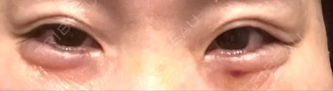 ボトックス（目尻） 湘南美容クリニック 大阪あべの院 DAY 6 メイン用