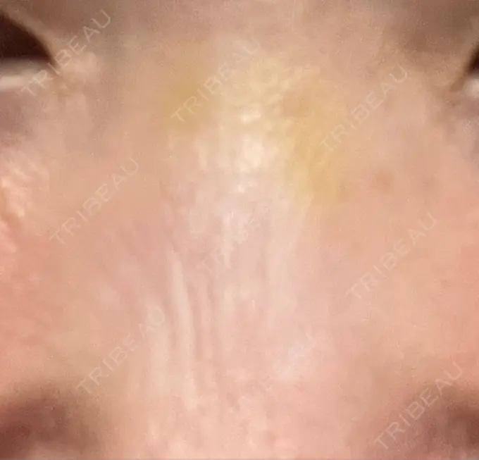 その他（鼻） 湘南美容クリニック 大阪あべの院 DAY 6 メイン用