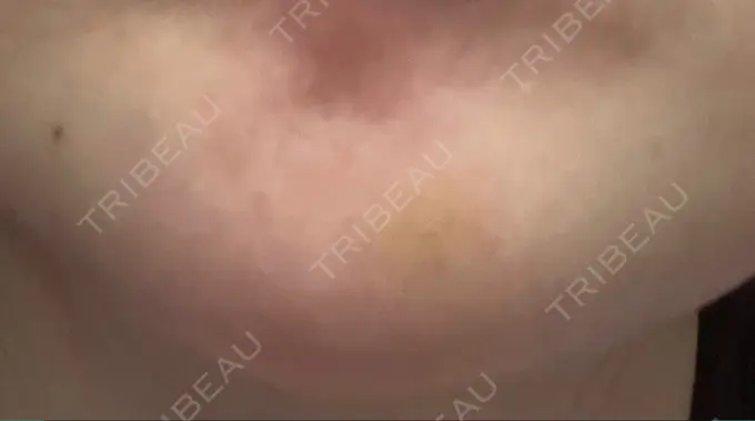 ボトックス（あご） 湘南美容クリニック 大阪あべの院 DAY 6 メイン用