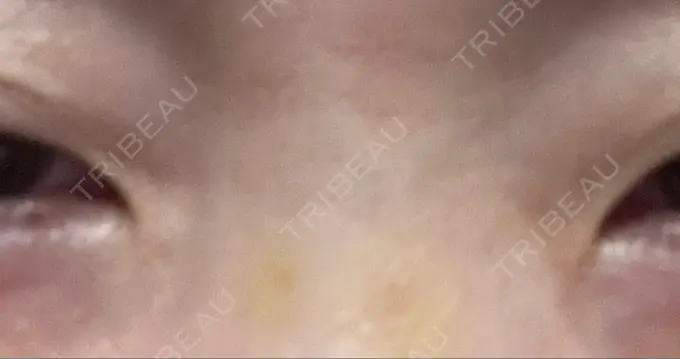 その他（目元） 湘南美容クリニック 大阪あべの院 DAY 6 メイン用