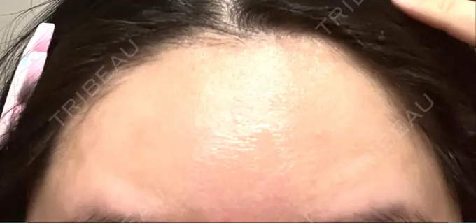 ボトックス（額） 湘南美容クリニック 大阪あべの院 DAY 6 メイン用