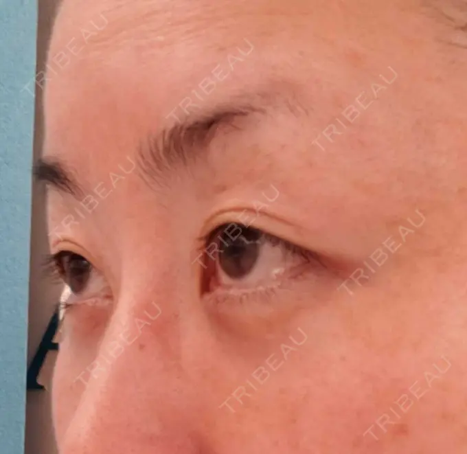 下まぶたたるみ取り / 下まぶたの脂肪取り / その他（目元） エースクリニック 名古屋院 DAY 29 メイン用