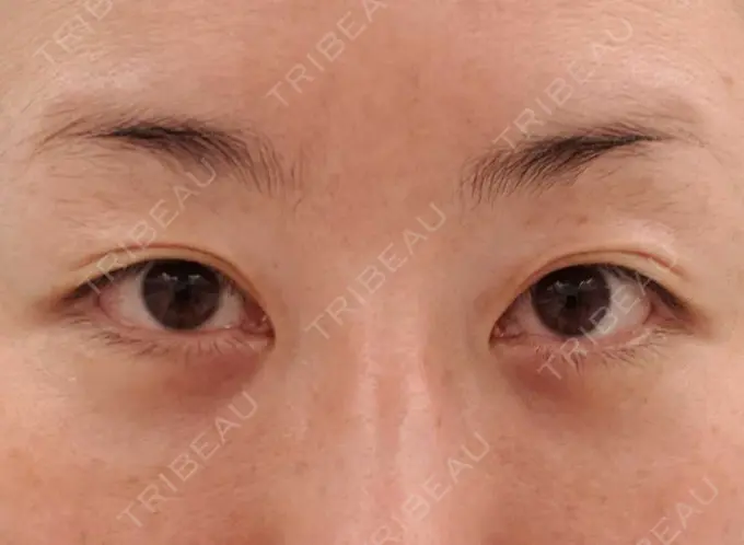 下まぶたたるみ取り / 下まぶたの脂肪取り / その他（目元） エースクリニック 名古屋院 DAY 29 メイン用