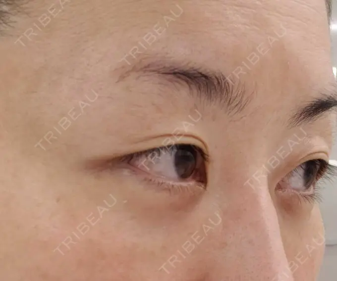 下まぶたたるみ取り / 下まぶたの脂肪取り / その他（目元） エースクリニック 名古屋院 DAY 29 メイン用