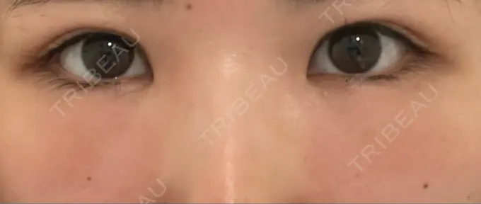 クマ治療 / 下まぶたの脂肪取り Brandnew Beauty Clinic DAY 1 メイン用