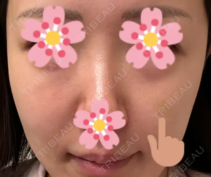 ヒアルロン酸注入（頬） 湘南美容クリニック 宇都宮院 DAY 7 メイン用