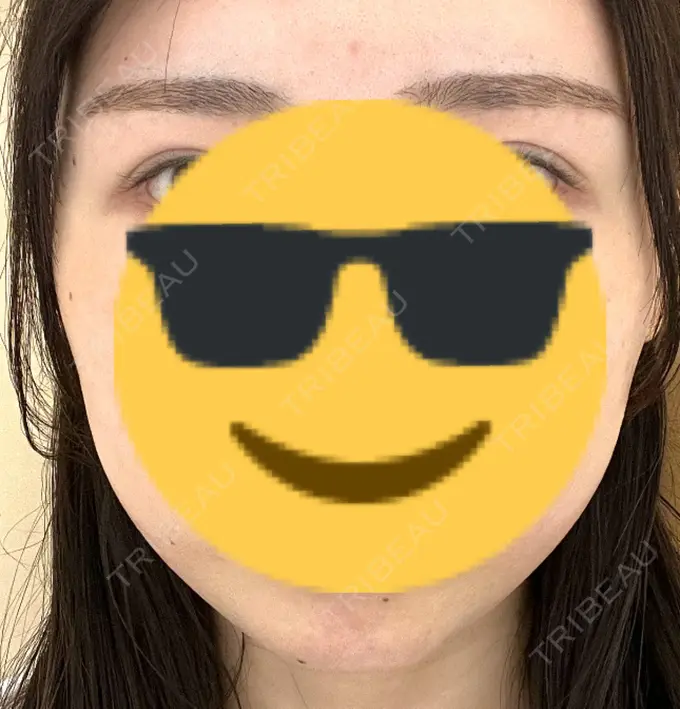 ハイフ（顔） A CLINIC（エークリニック） 横浜院 DAY 1 メイン用