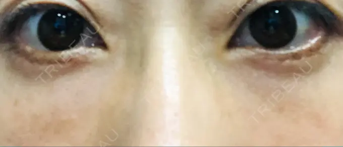 クマ治療 / 下まぶたたるみ取り / 脂肪注入（目の下） 湘南美容クリニック Regno 銀座院 AFTER メイン用